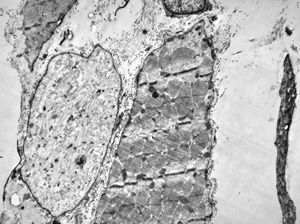 F,56y. | regenerating muscle cell